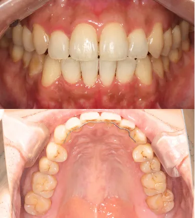 矯正治療後（After）