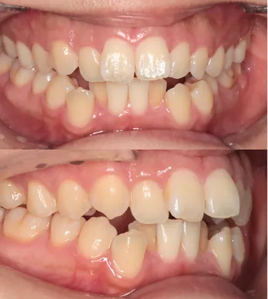 矯正治療前（Before）