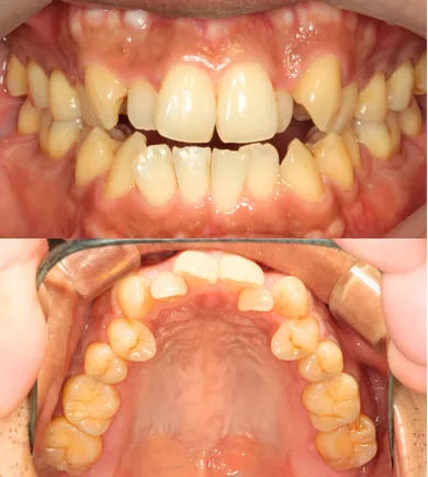 矯正治療前（Before）