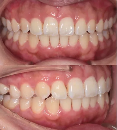 矯正治療後（After）