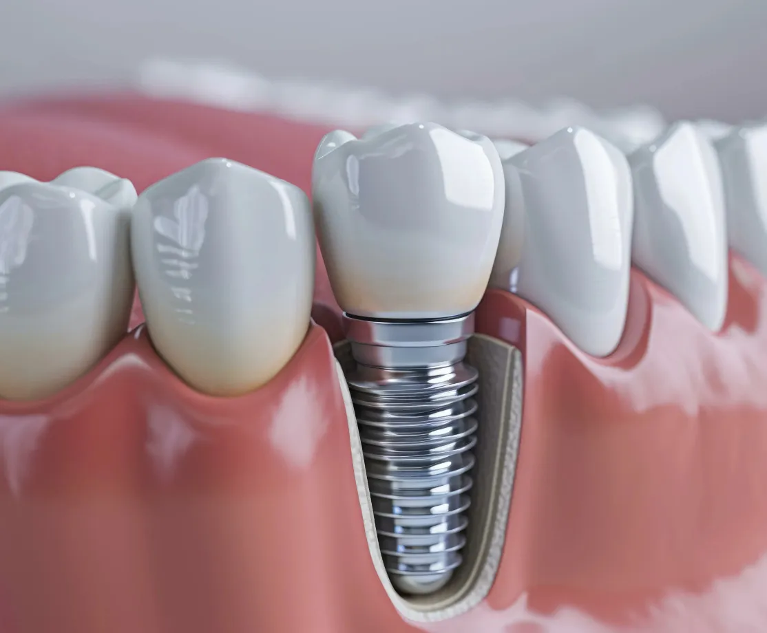 たまプラーザ駅徒歩3分の歯医者・歯科「たまプラーザむろき歯科・矯正歯科」｜歯を失ったオプションとして次の歯を守る為のインプラント治療