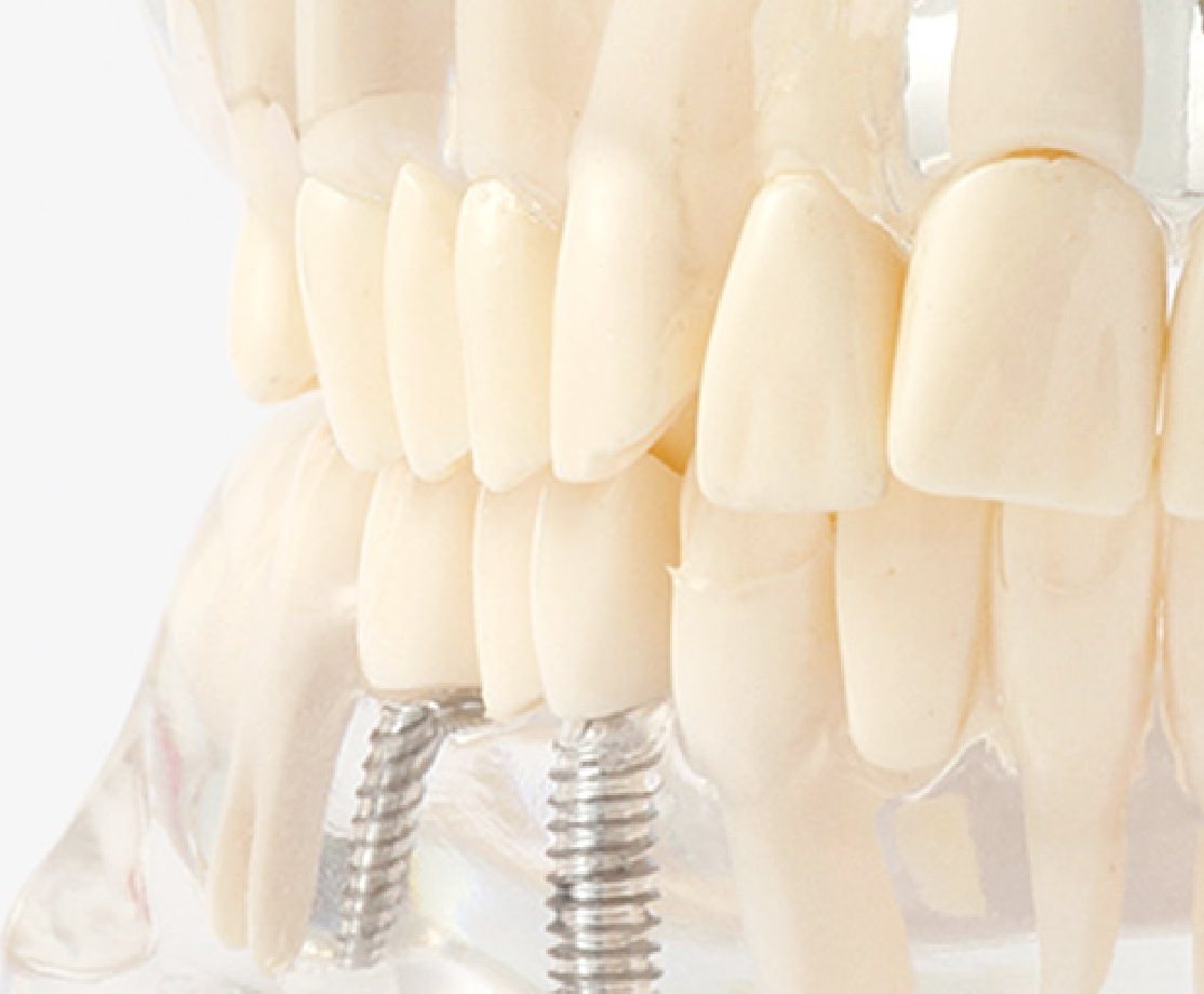 歯を失ったオプションとして次の歯を守る為のインプラント治療